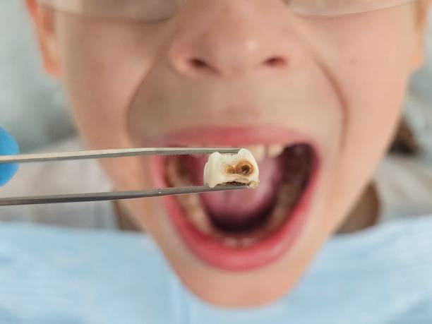 Best Emergency Dental Care for Abscessed Tooth in Crandall, TX